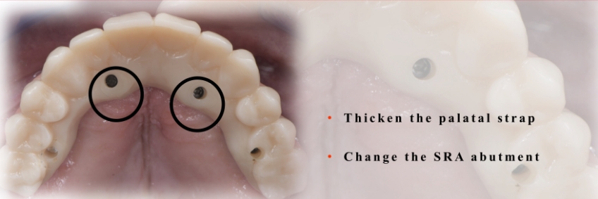 Note the access holes to the anterior implants.