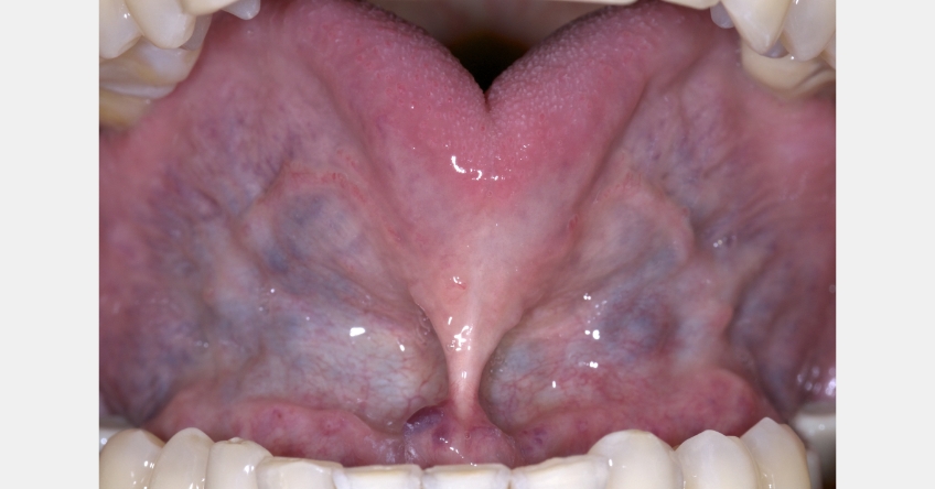 close up of tongue as it relates to sleep apnea