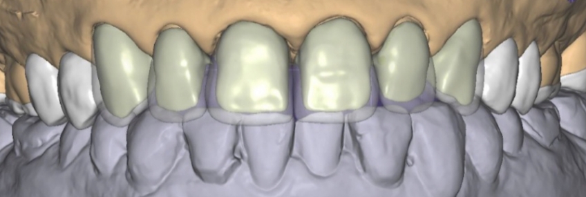 Digital scan with anterior design prepared for layering and posterior design for monolithic restorations