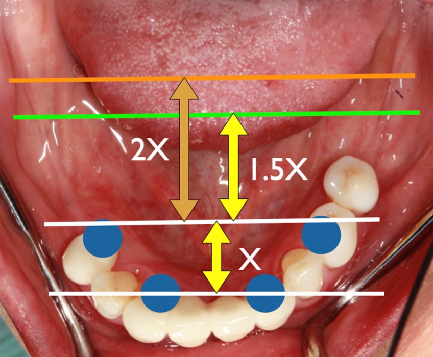 The anterior to posterior or “AP spread” as a guideline for cantilever extension