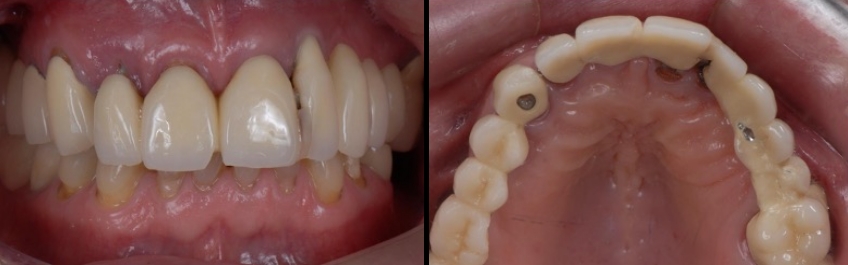 Preoperative view of the worn/ill-fitting previous porcelain fused to metal reconstruction.