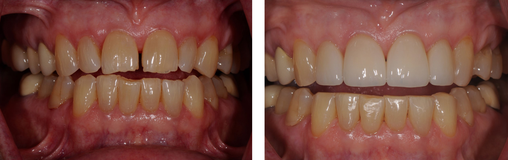 A successful veneer case — pre-treatment and post-treatment.