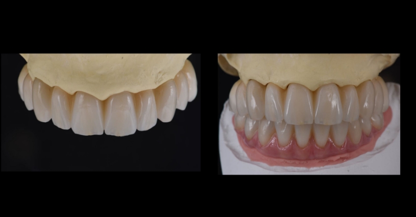 Fabrication of the definitive minimally layered zirconia reconstruction.