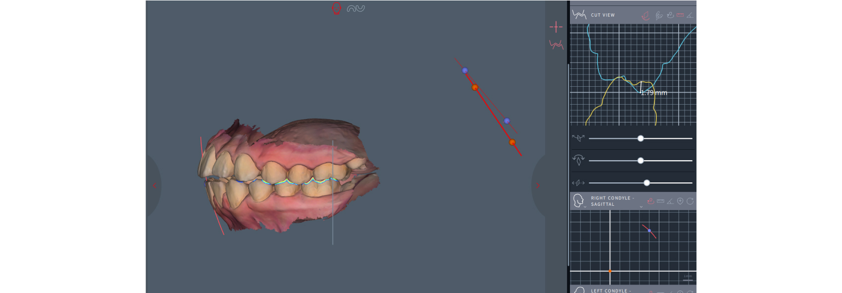 Figure 4: The patient virtually equilibrated to the next anterior point of contact to measure the intrusion or loss of vertical dimension at the second molar. This can be visualized and measured virtually on a digital articulator, and in this example in Modjaw