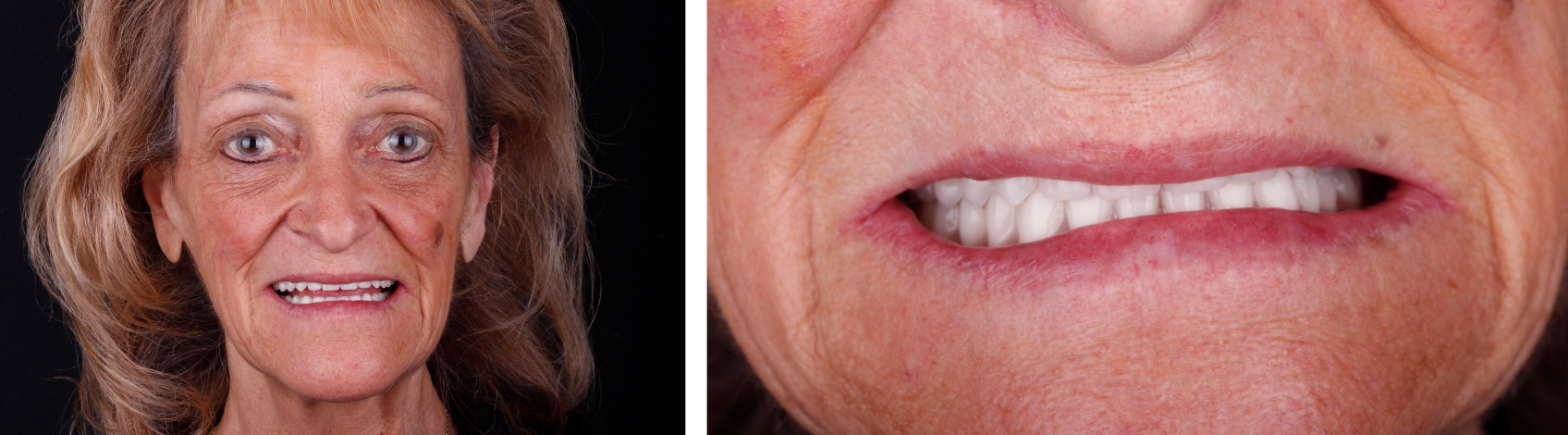 This patient liked the fit and aesthetic appearance of her existing dentures, but their worn occlusal surfaces meant the dentures weren't functioning properly