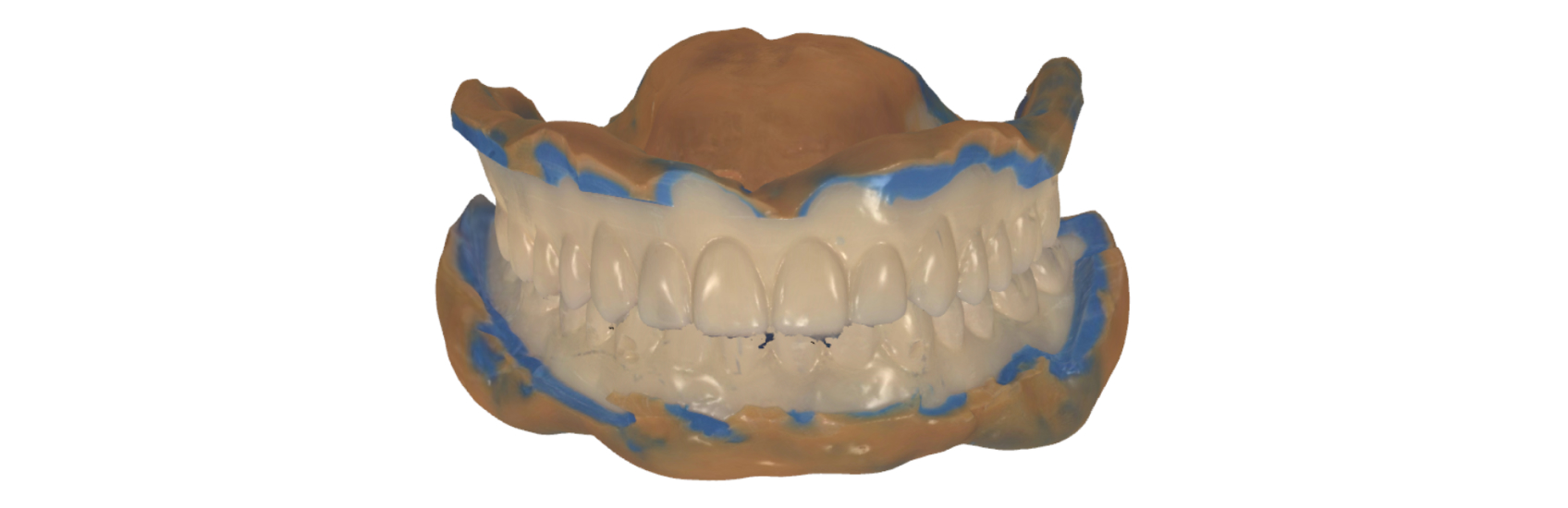 The patient's scanned wash impression