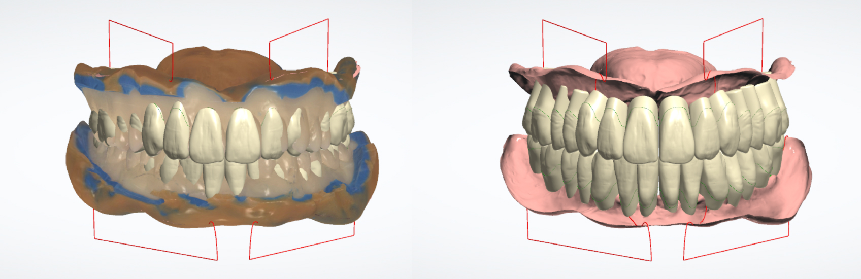 The reference denture scan that was used as a guide. The lab-designed new tooth arrangement