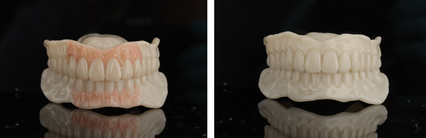 Two functional try-ins helped the patient experience how the final denture would feel and also review her naturally high smile line