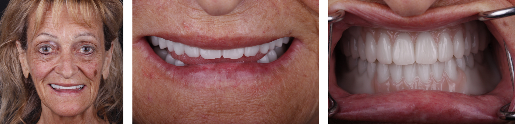 Testing the functional try-in dentures