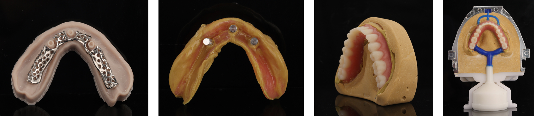 A metal mesh framework (Fig. 27) was embedded inside a cast created from a final impression (Fig. 28) and covered by molding material (Fig. 29) to reinforce the strength of the mandibular denture (Fig. 30).