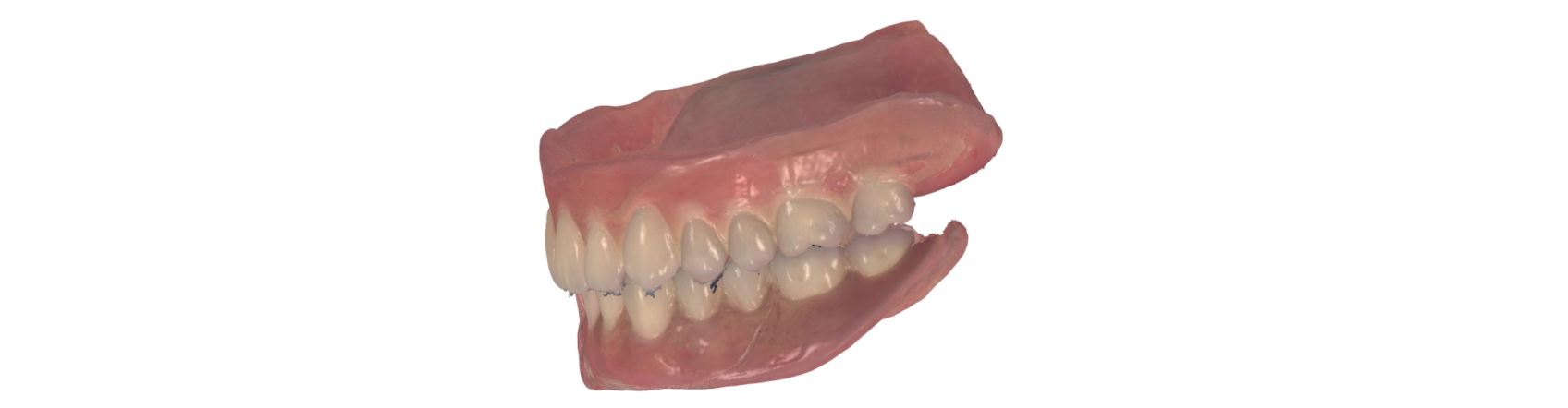 The patient's scanned denture.