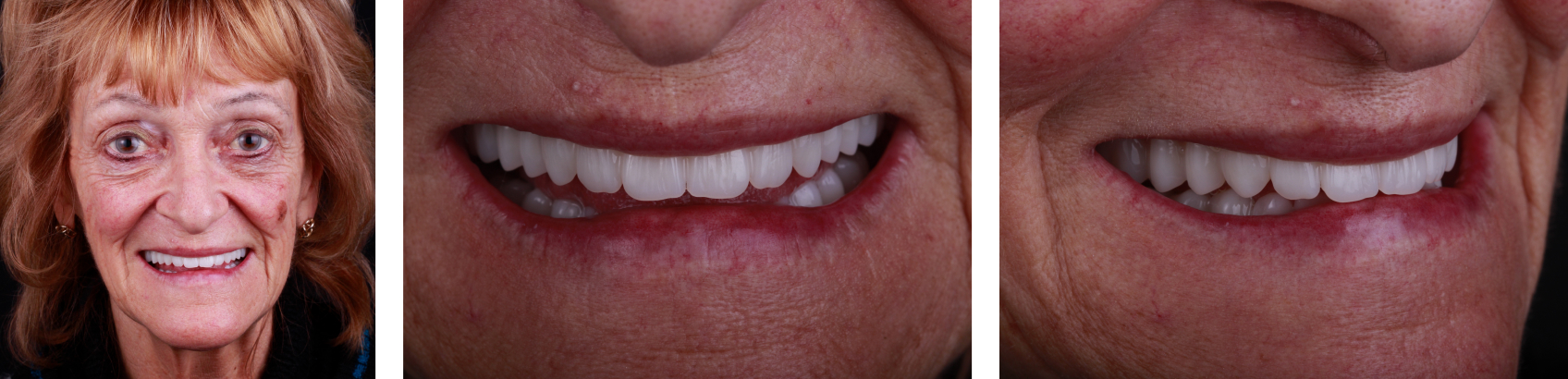 The final dentures in the patient's mouth