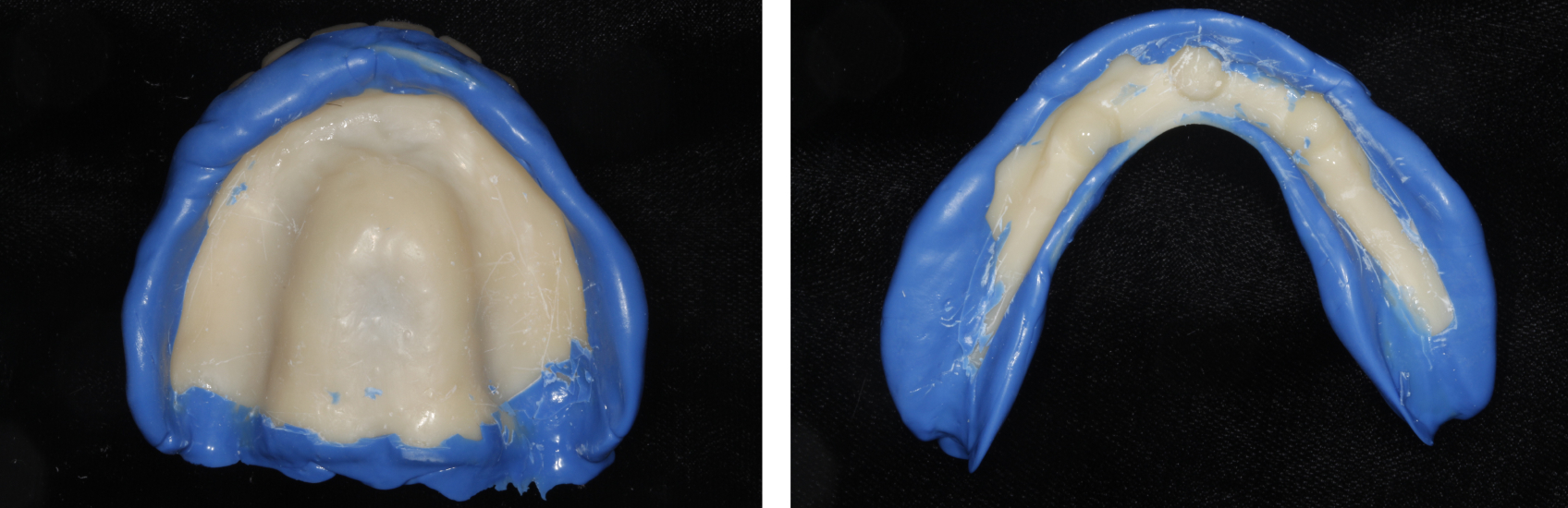 Capturing the borders of the upper and lower dentures, respectively, with heavy-body impression material.