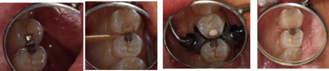 Two Methods Of Indirect Pulp Capping For Removing Caries Spear Education