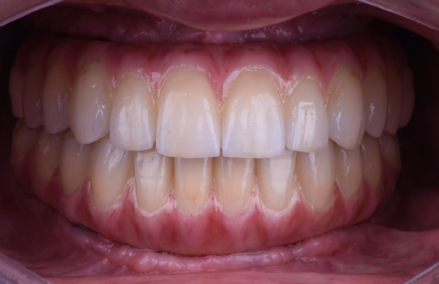 terminal dentition 