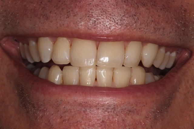 dental composite comparison figure 2