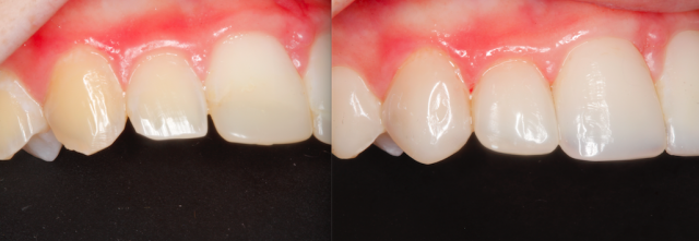 dental composite comparison figure 8