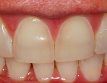 uncommon pattern of dental erosion figure 2