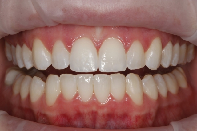 esthetic restorations chipped tooth