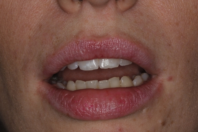 lip at rest close up dental patient photo