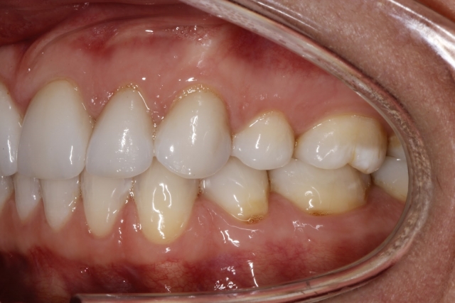 teeth retracted lateral view dental patient photo 1