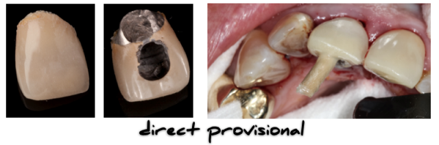 Implant Working Cast Part 2 Figure 3