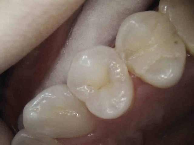 caries detection figure 6