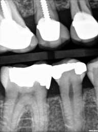 caries detection figure 9