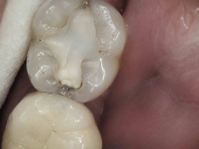 caries detection figure 16