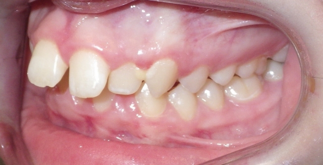 optimal orthodontic referral timing figure 5