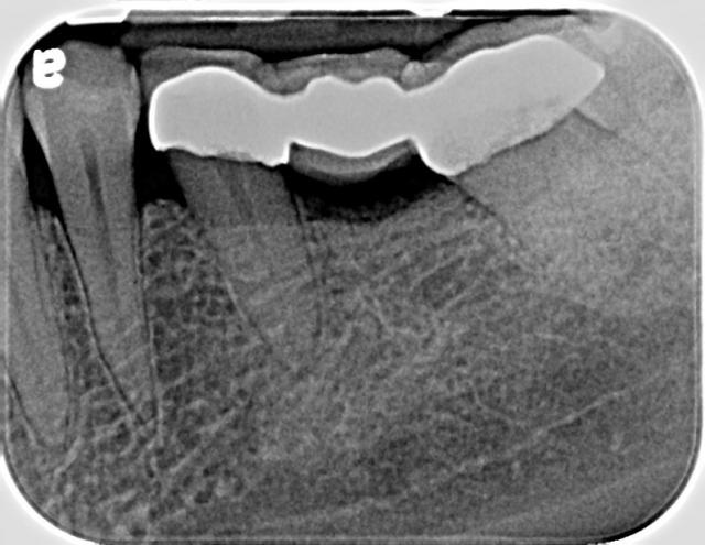 implants figure 1