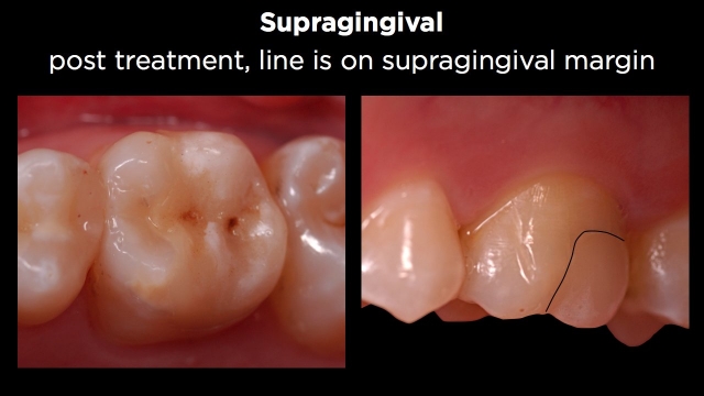 Facial Margin Treatment Figure 3