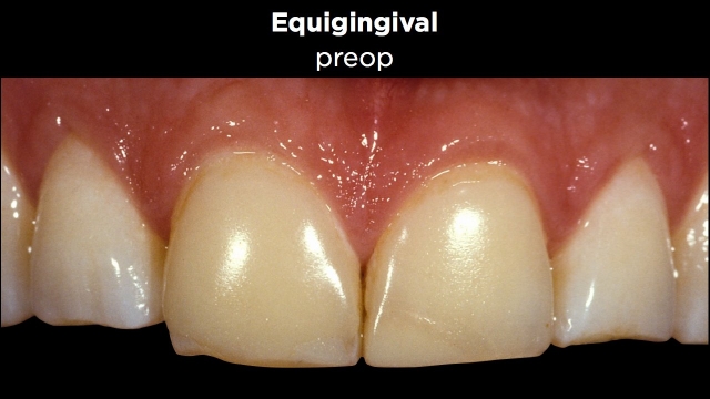 Facial Margin Placement Figure 4