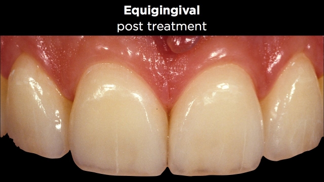 Facial Margin Placement Figure 6