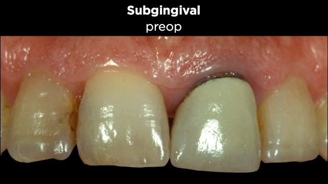 Facial Margin Placement Figure 7