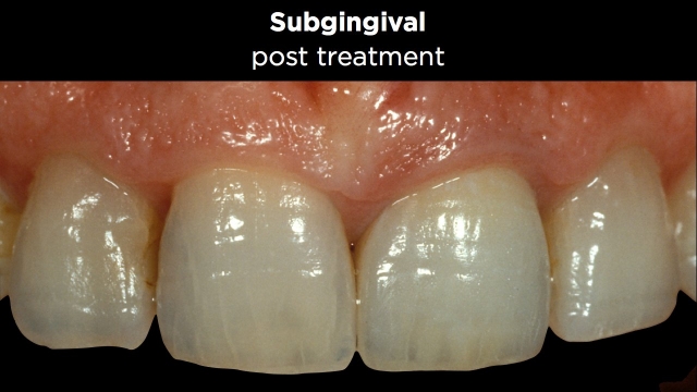 Facial Margin Placement Figure 9