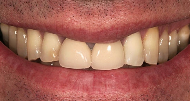 facial margin placement figure 1