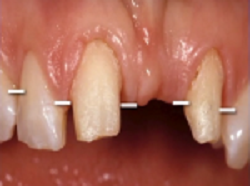 free gingival margin ovate pontics