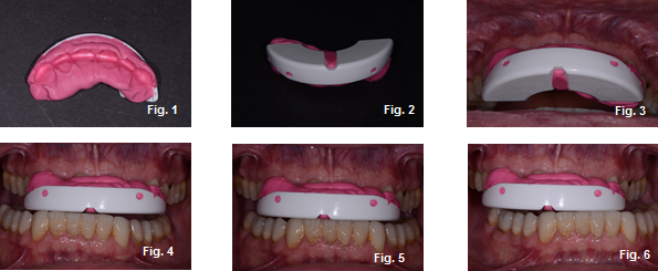 temporary occlusal appliances figures 1-6