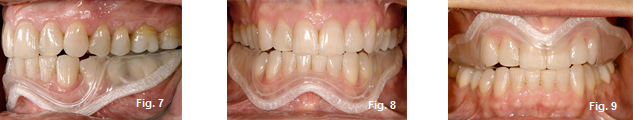 temporary occlusal appliances figures 7-9