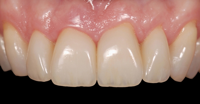 existing interproximal restorations figure 1c