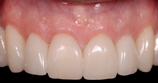 open gingival embrasures figure 2c