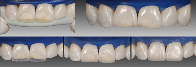 Using glycerin on composite restorations