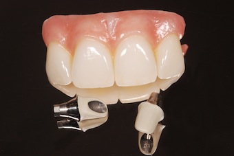 screw retained implant restoration