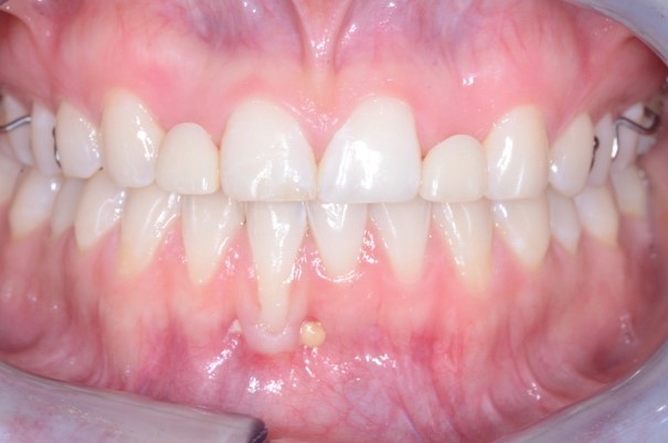 patient teeth showing complex issues including divergent roots, tooth size and proportion