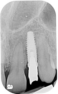 final implant x ray