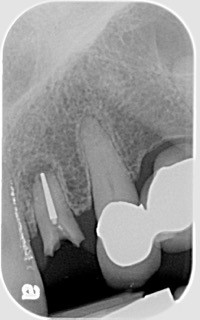 dental x ray before implant loading