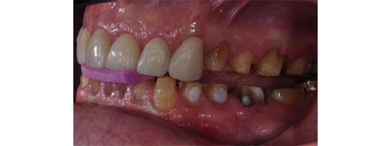 Vertical dimension / prepared posterior teeth