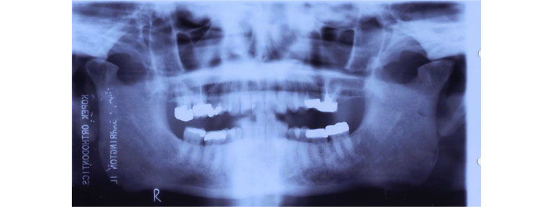 Panoramic x-ray