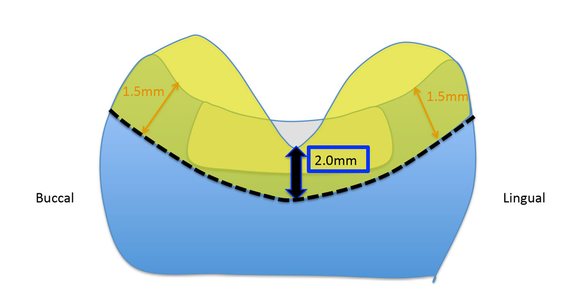 diagram showing buccal and lingual with a large v-shaped area showing a 2mm a difference in the middle and 1.5mm on both sides.